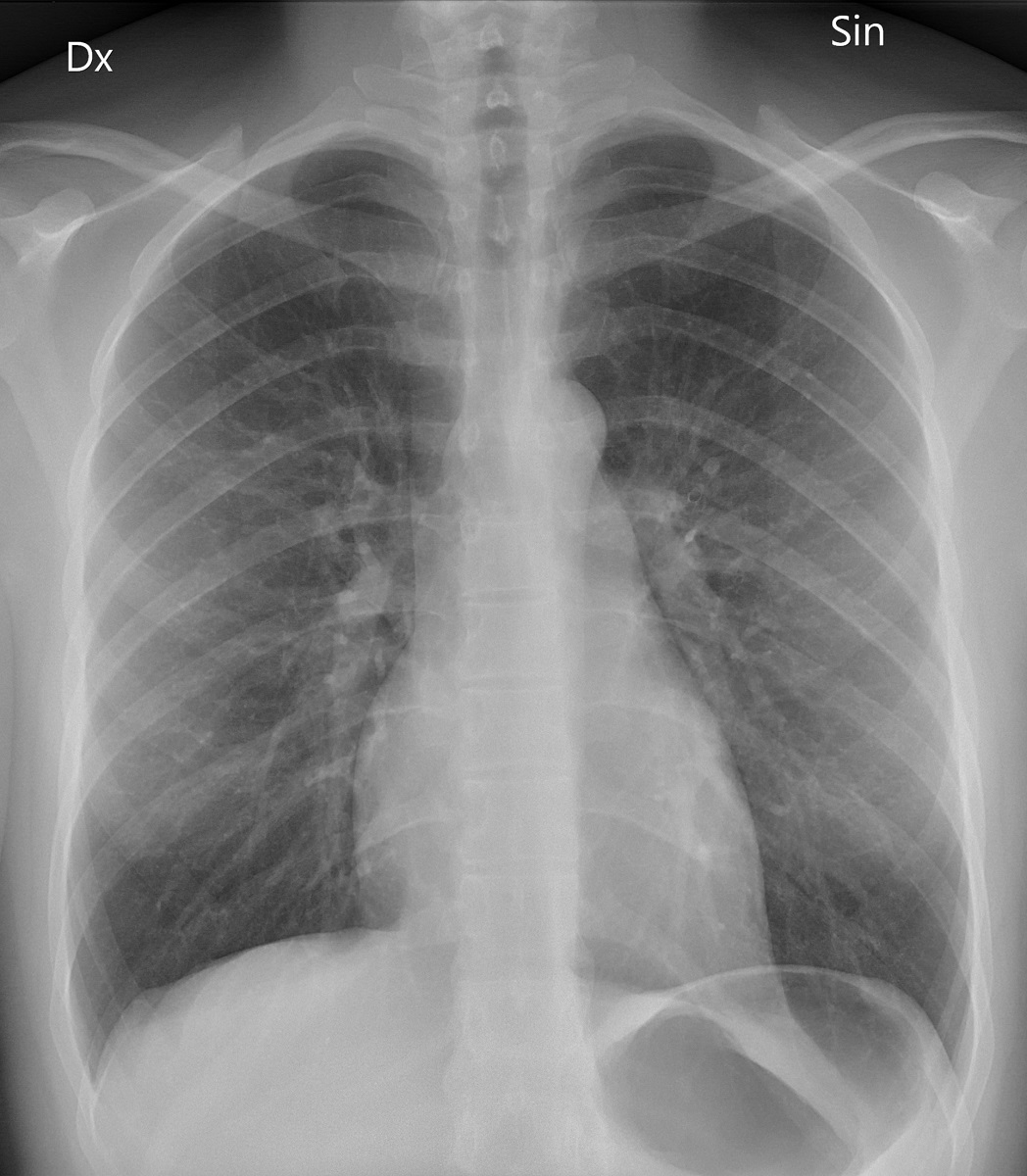 Chest X Ray image